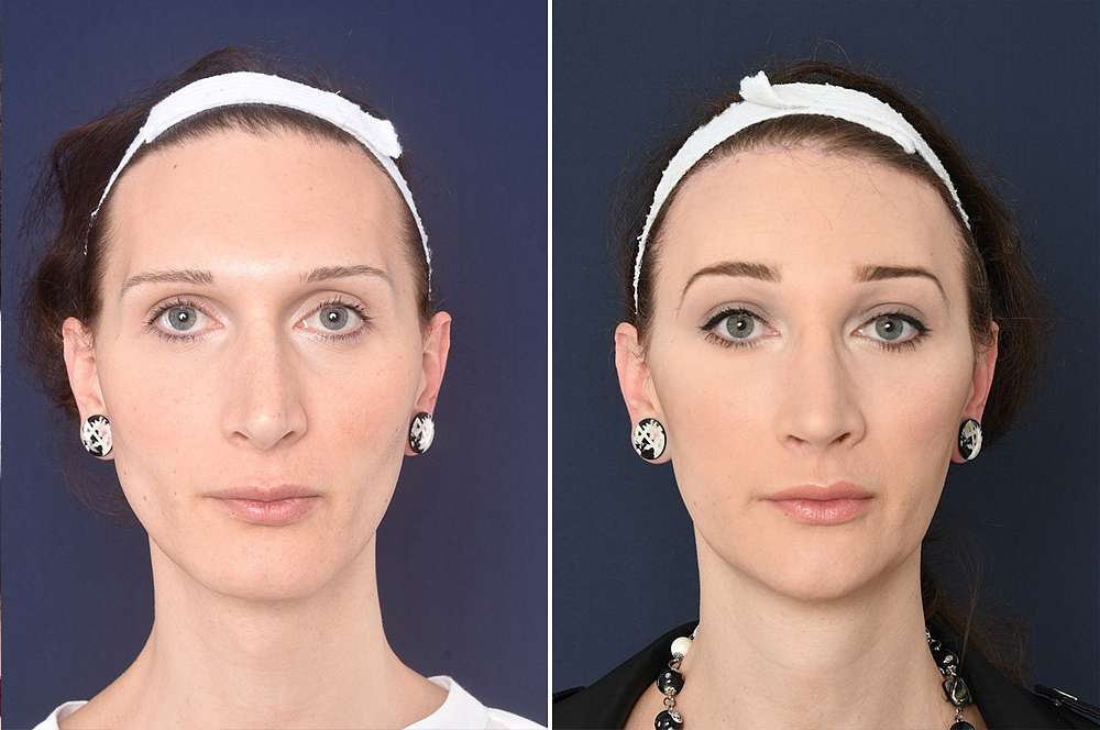 Facial feminization in the united states
