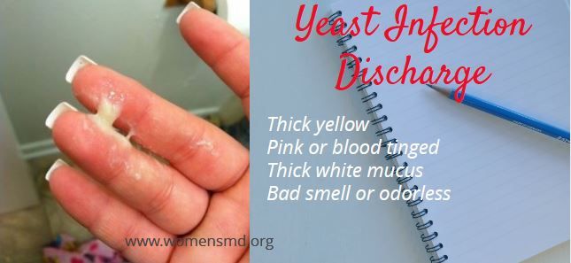 Thick yellow vaginal discharge