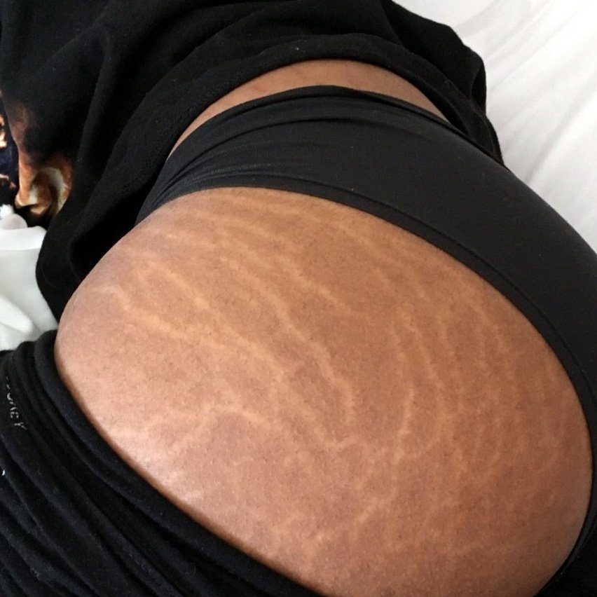 Sexy ass with stretch marks