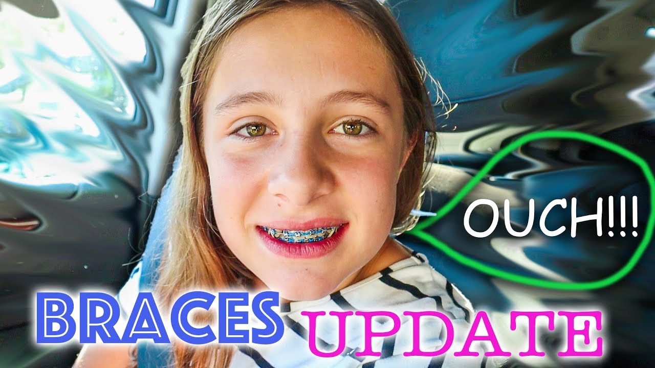 Teen braces facial caption