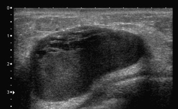 Complex cysts in the breast