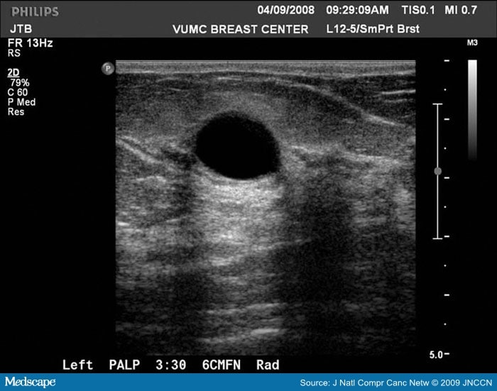 Complex cysts in the breast
