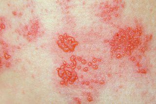 Recurrent shingles in adults