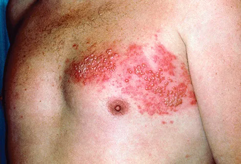 Recurrent shingles in adults