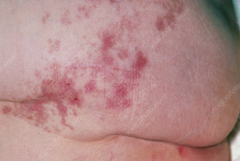 Recurrent shingles in adults