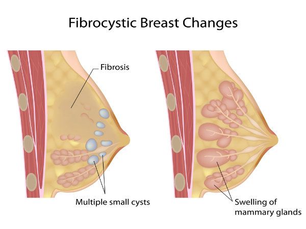 Shape of breast fibroids