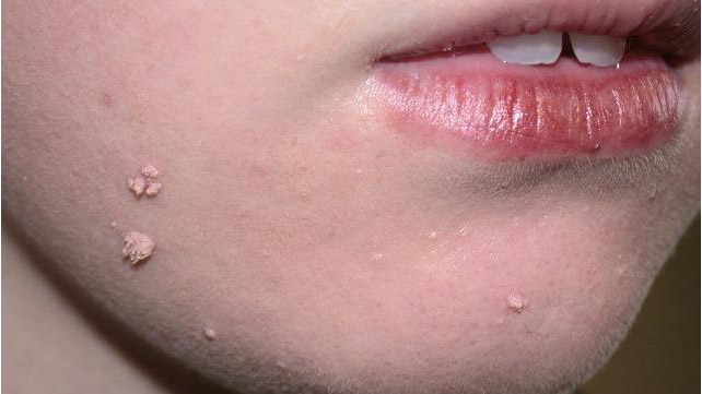Toddler bumps under skin near vagina