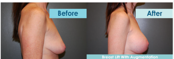 Cosmetic breast lift procedure