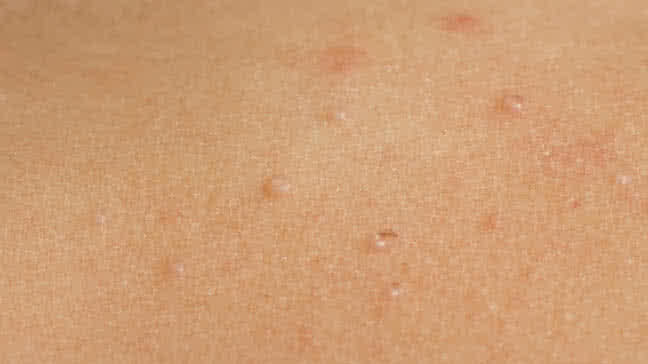 What causes molluscum contagiosum in adults