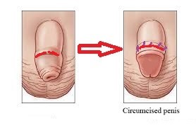 Circumcision for adults in singapore