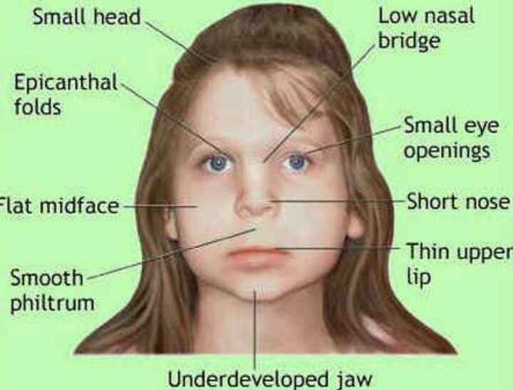 Fetal alcohol syndrome face